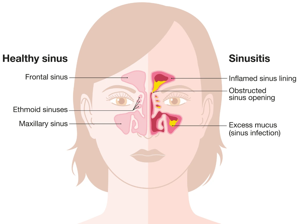 Sinusitis