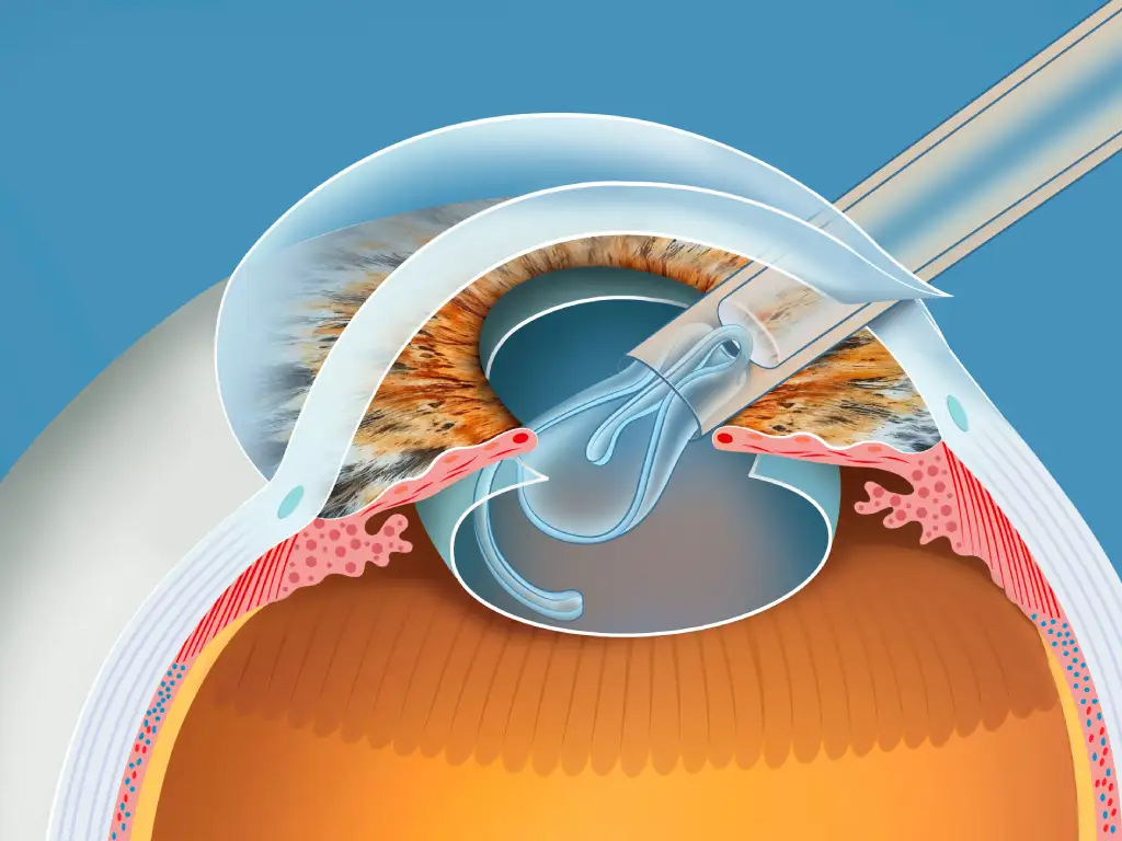 Cataract Surgery Singapore