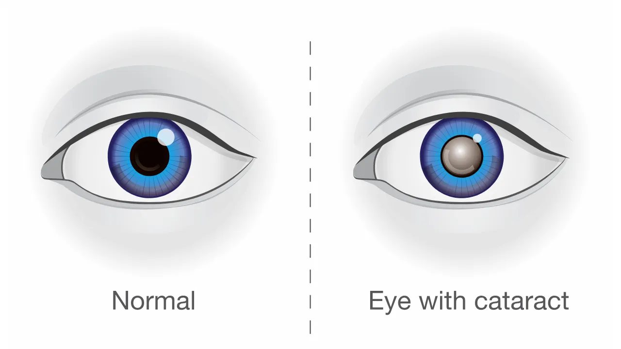 Cataract Symptoms