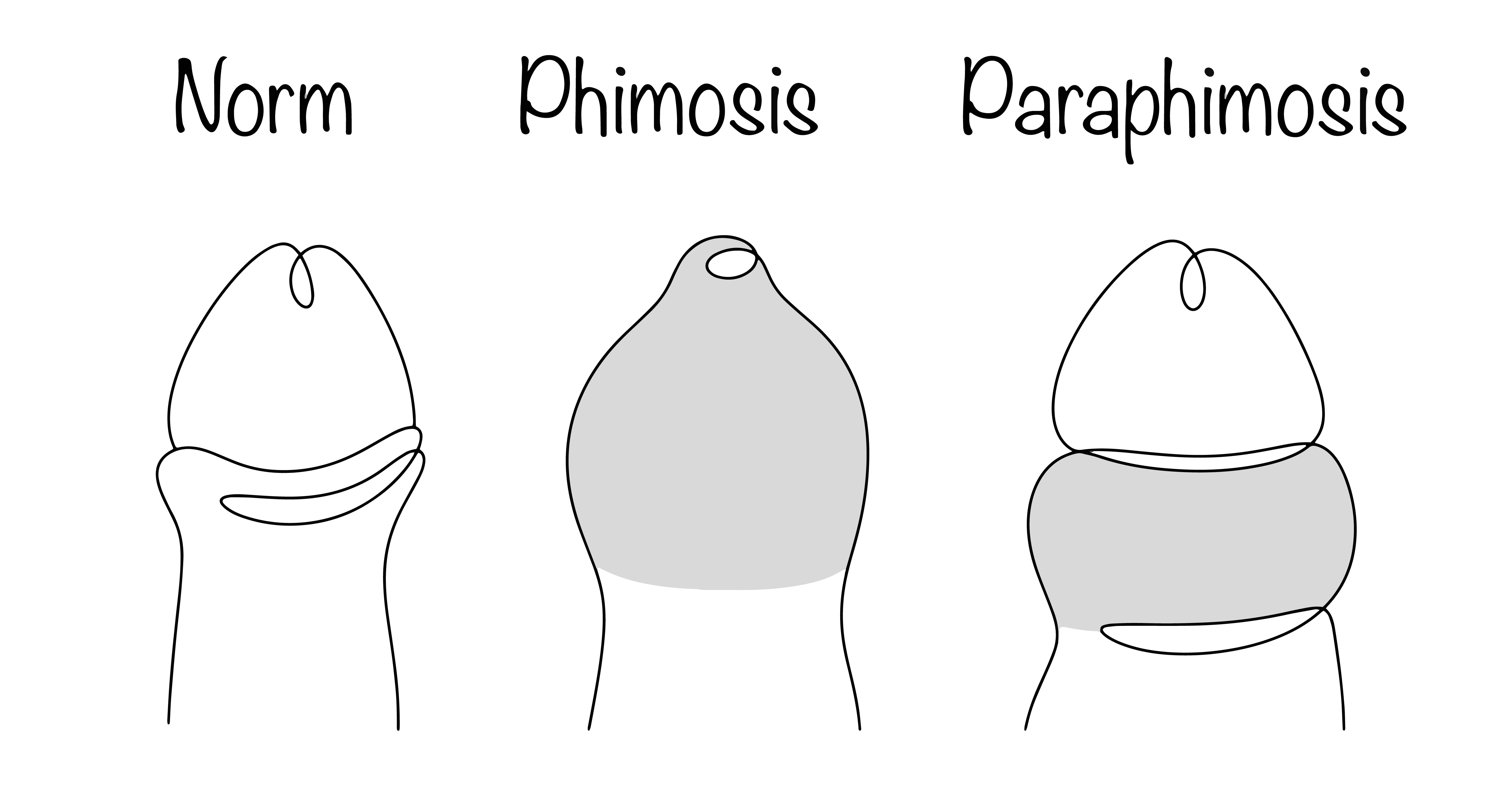 Phimosis in Children