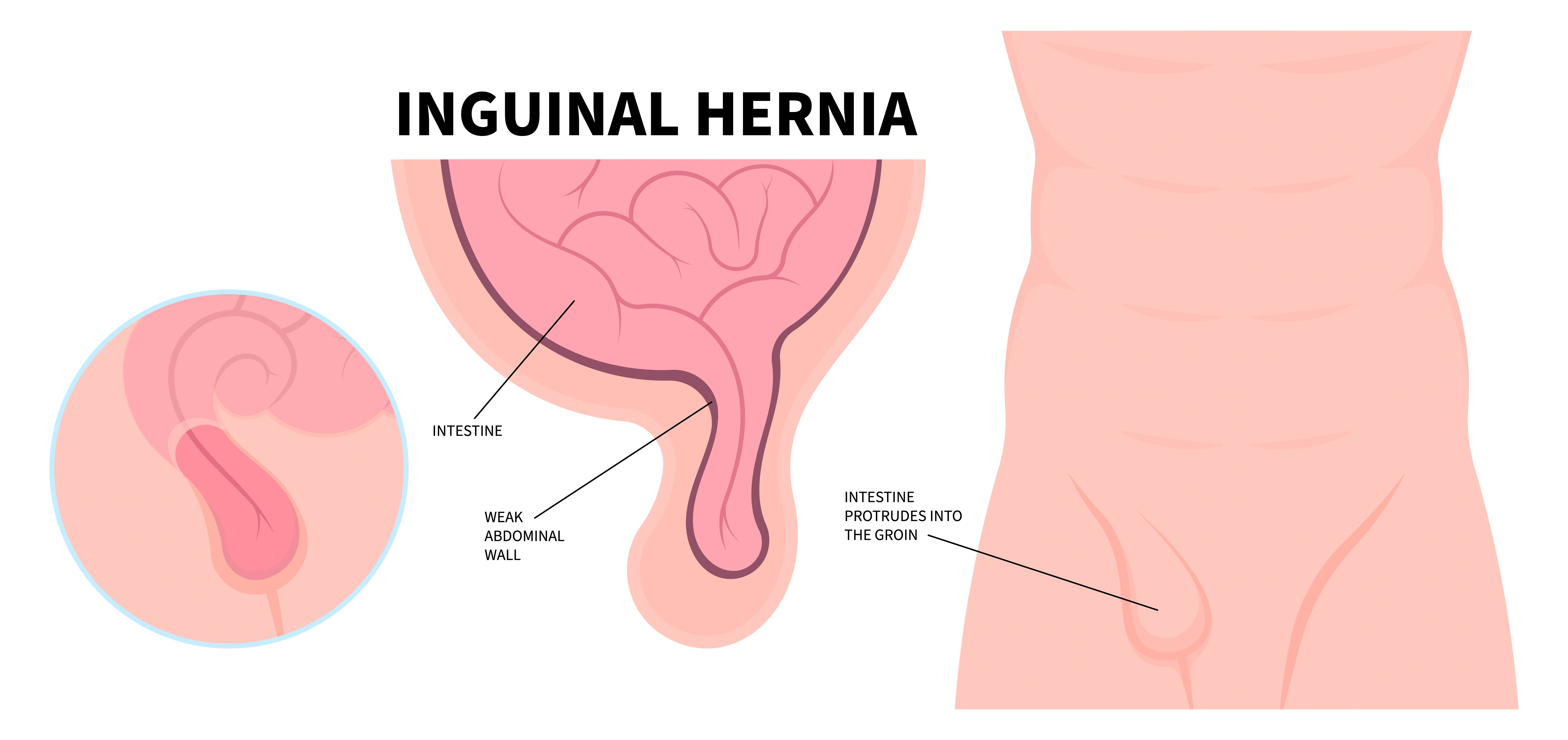 Inguinal Hernia in Children
