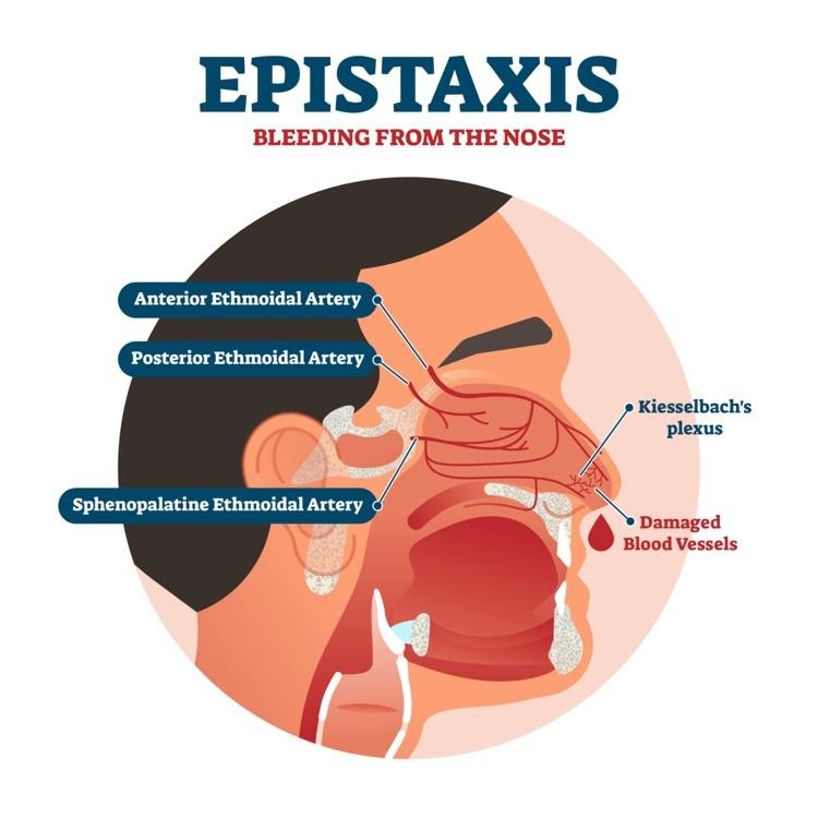 Nosebleeds Causes, Treatments, Measures to Reduce Nosebleeds