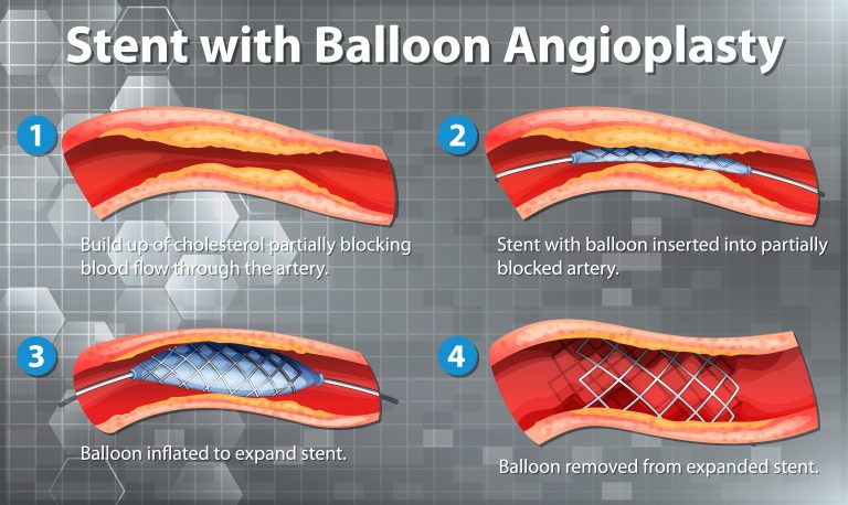 Tonen Met opzet salto What is Angioplasty? - Nobel Medical Group