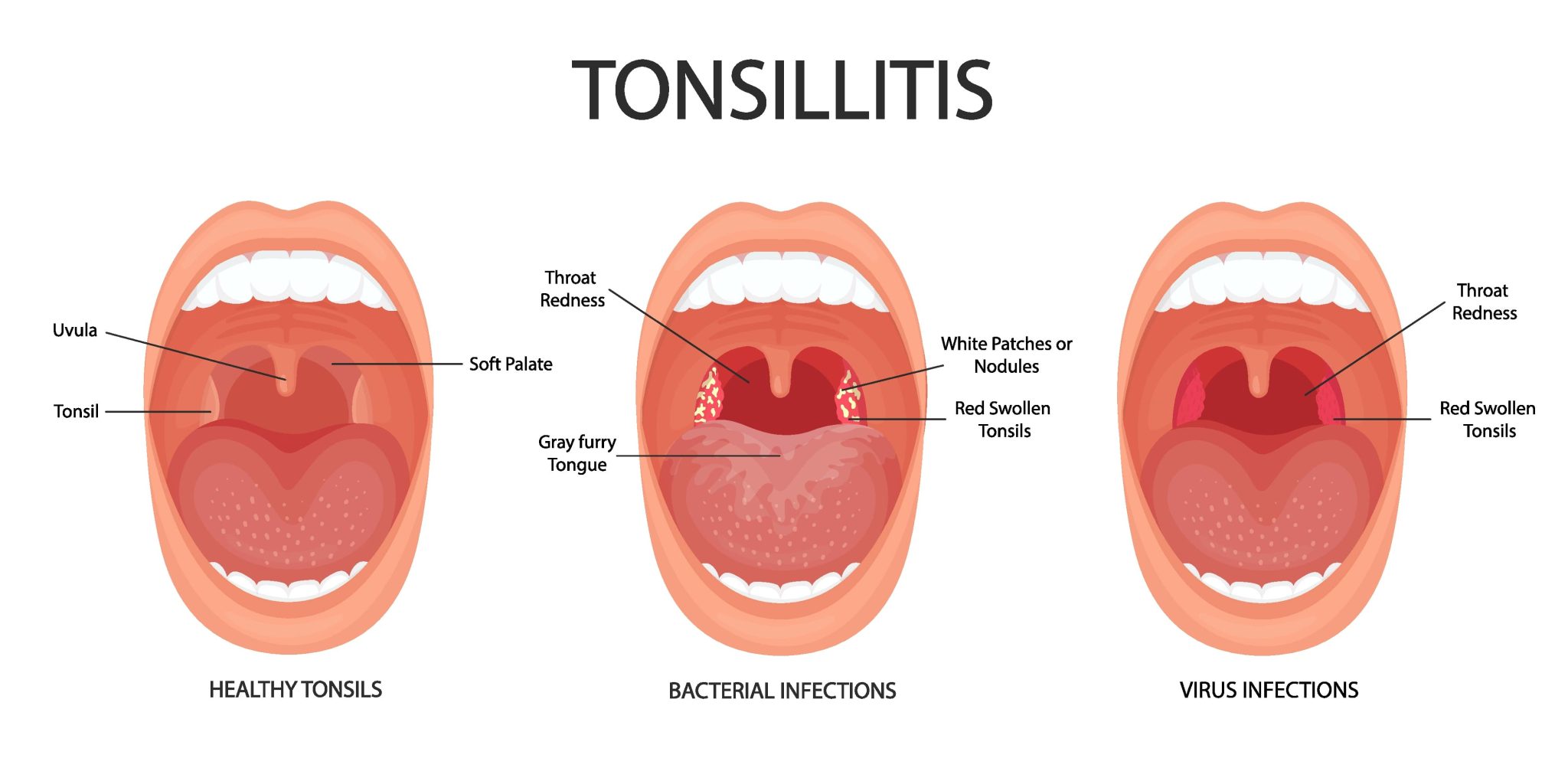 Tonsillitis Causes Symptoms And Treatment Nobel Medical Group