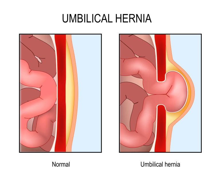 Hernia in Children - Nobel Medical Group